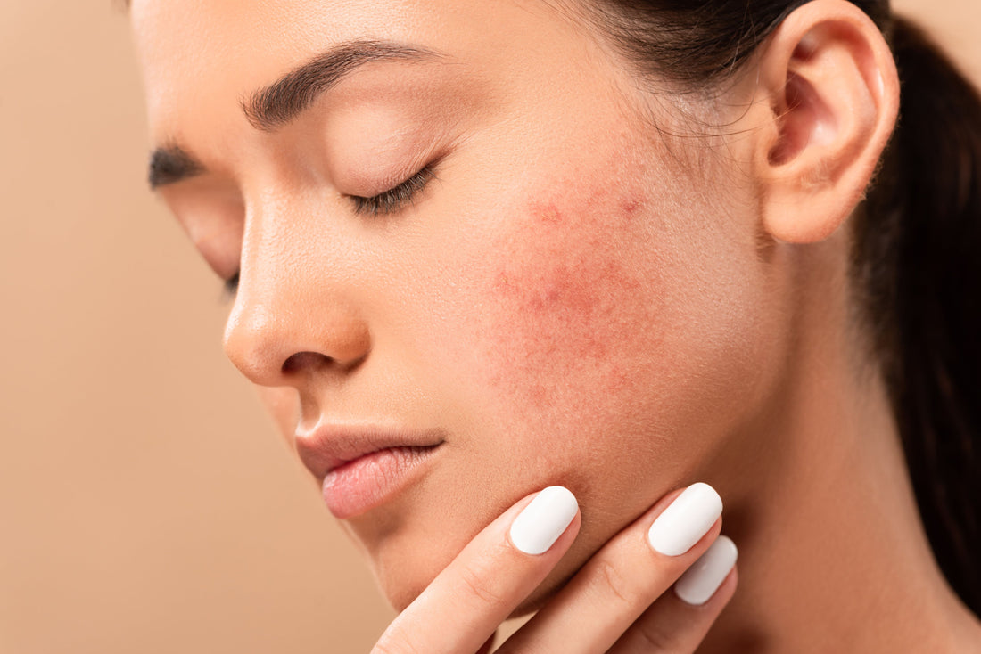 A woman with an acne breakout on her faces