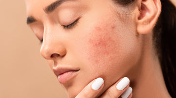 Can CBD Help With Skin Conditions Like Acne?